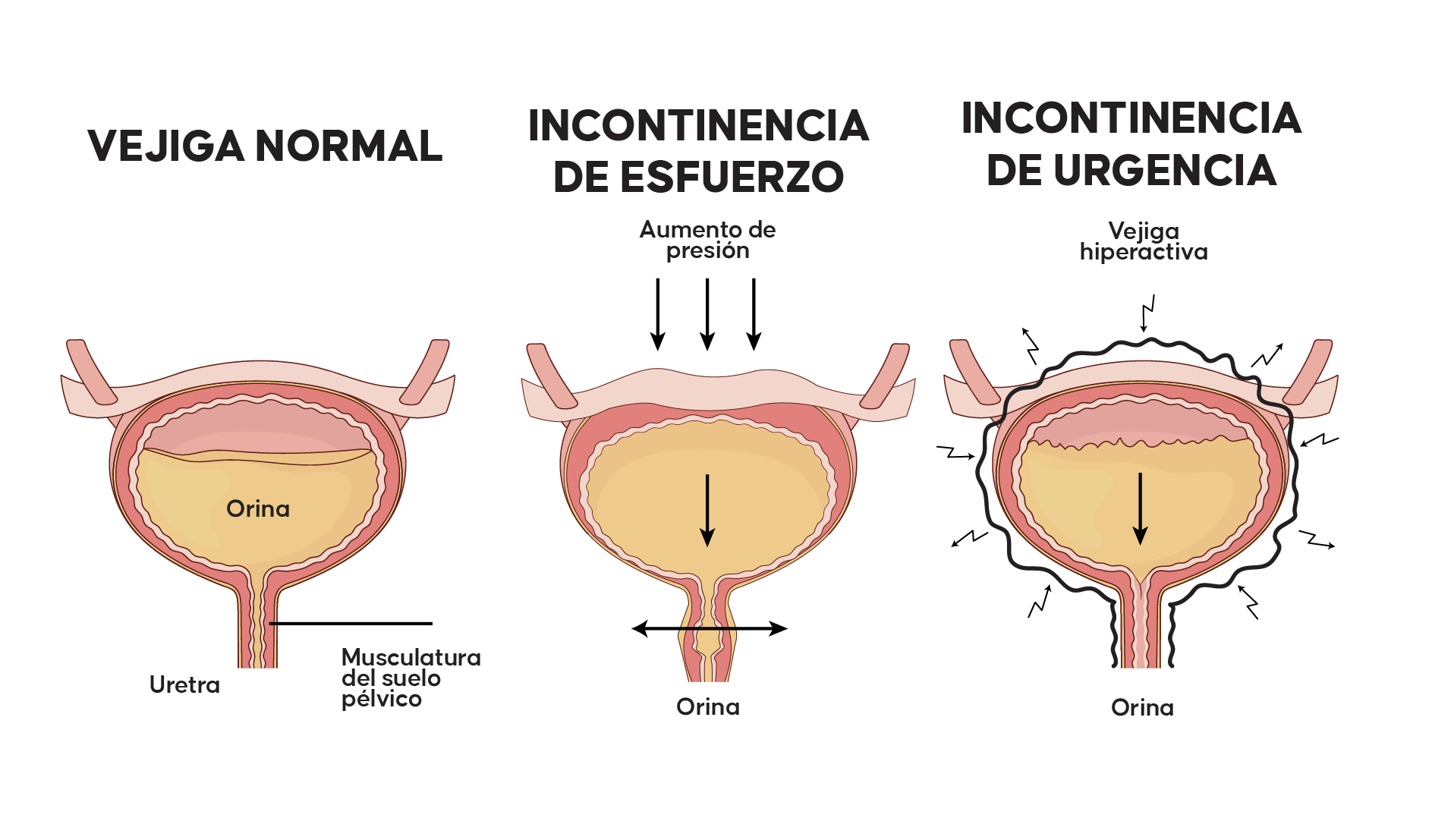 Incontinencia-Urinaria Incontinencia-Urinaria